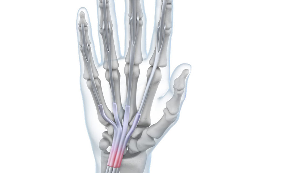 Tendonitis Biology Diagrams